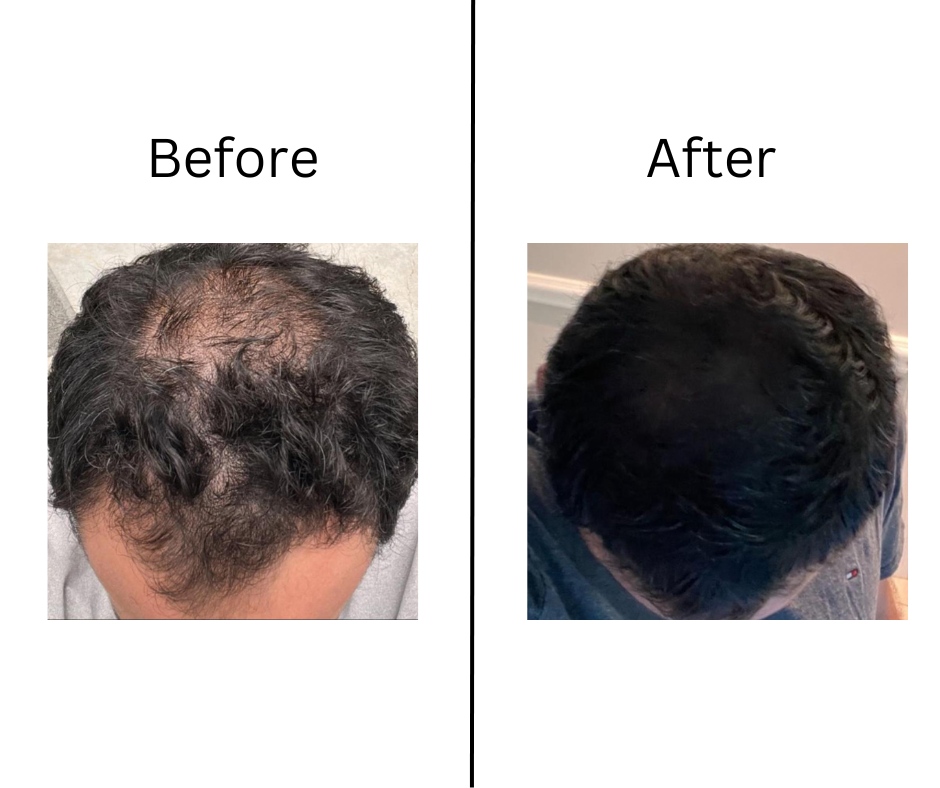 Before After Hair Loss